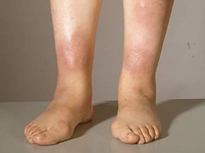 Erythema nodosum