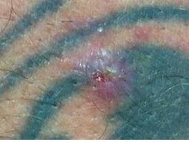 Hautkrebs im Tattoo