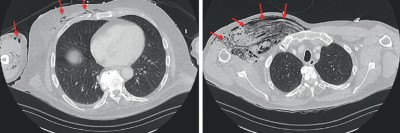 fulminantes Gasgangrän des rechten Hemithorax