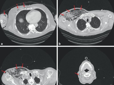 fulminantes Gasgangrän des rechten Hemithorax