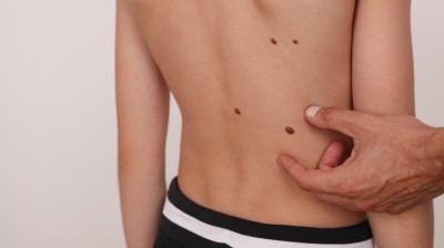 Arzt untersucht Muttermale eines Kindes
