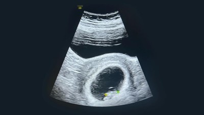 Ultraschall in der 8. Schwangerschaftswoche