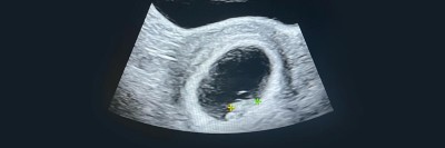 Ultraschall in der 8. Schwangerschaftswoche