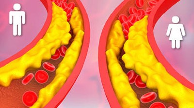 LDL-Webcast