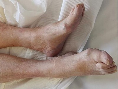 Nach außen rotierter Fuß nach Oberschenkelhalsfraktur