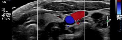 Drohende ösophago-arterielle Fistel nach Batterieingestion