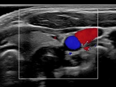 Drohende ösophago-arterielle Fistel nach Batterieingestion