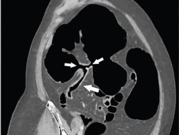 CT-Kolonografie