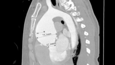 CT scan of post-dissection aneurysm in pregnant patient