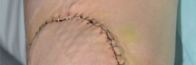 Stumpfende des Oberschenkels nach Unterschenkel-Amputation