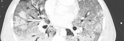 Acute Respiratory Distress Syndrome (ARDS)