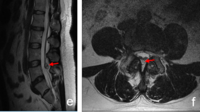 Imaging of patient with gouty lumbar spinal stenosis