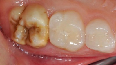 Zahnreihe in Aufsicht auf Kaufläche mit Molar mit Molaren-Incisiven-Hypomineralisation