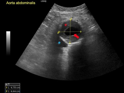 Bauchaortenaneurysma im Ultraschall