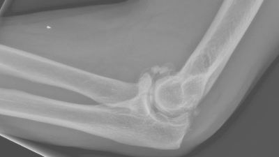 Arthrose im Ellenbogen