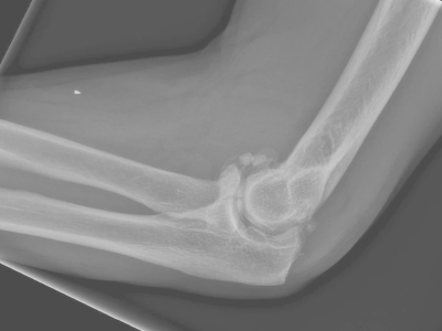 Arthrose im Ellenbogen