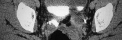Computertomographie eines distalen Harnleitertumors links