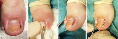 Chirurgische Behandlung eines eingewachsenen Zehnagels