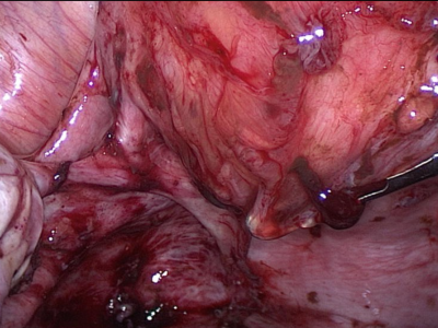Endometriose und Adenomyose am Uterus