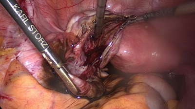 Operation einer Endometriosezyste