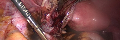 Operation einer Endometriosezyste