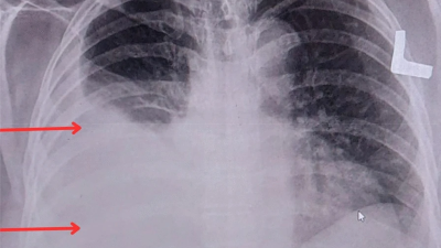 Chest x-ray of patient with synchronous breast cancer and pleural mesothelioma