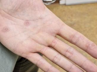 Hand-Fuß-Mund-Krankheit