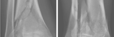 Varusfehlstellung der Tibia