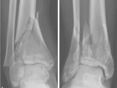 Varusfehlstellung der Tibia