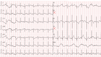 ECG of infant with Kawasaki disease and supraventricular tachycardia