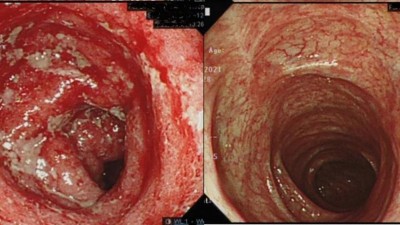  Endoscopic view before and after upadacitinib salvage therapy for acute severe ulcerative colitis