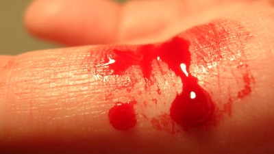 blutender Finger