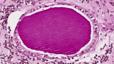 A Rathke’s cyst with periodic acid–Schiff stained content 
