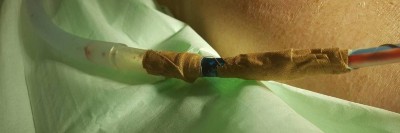 Thoraxdrainage: fraglicher Diskonnexionsschutz durch Fixierpflaster