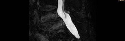 Lendenwirbelsäule: Spondylolisthese mit aktivierter Osteochondrose (STIR Sequenz)