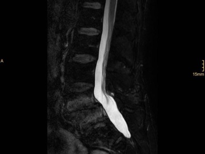 Lendenwirbelsäule: Spondylolisthese mit aktivierter Osteochondrose (STIR Sequenz)
