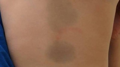 Ein Jahr altes Kind mit kongenital dermaler Melanozytose 