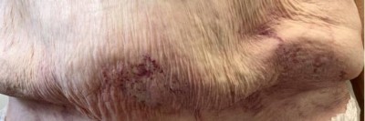 Schmerzende livide Areale am Bauch