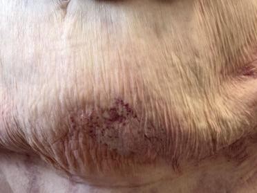 Schmerzende livide Areale am Bauch