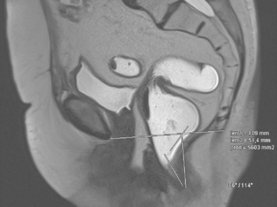 Magnetresonanz-Defäkographie des Rektums