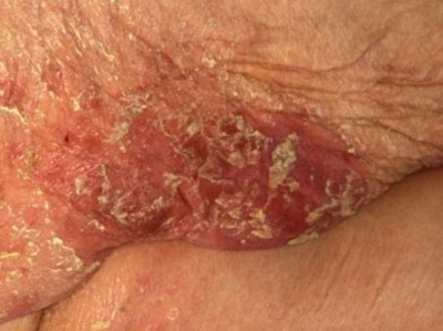 Inkontinenzassoziierte Dermatitis