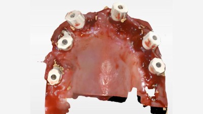Bild intraoral eines Oberkiefers mit Scanbodies