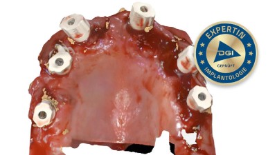 Bild intraoral eines Oberkiefers mit Scanbodies