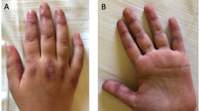 Photo of hand of patient with juvenile dermatomyositis