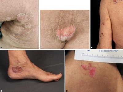 Hautreaktion unter Pembrolizumab und Enfortumab Vedotin