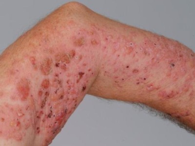Medikamentös induziertes bullöses Pemphigoid