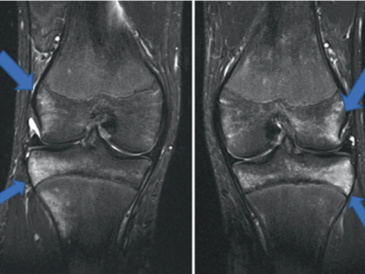 Knie-MRT zeigt überlastungsbedingte Knochenmarködeme