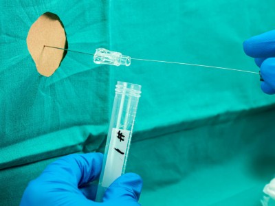 ’Carotid spells’ - transient focal neurological episodes associated ...