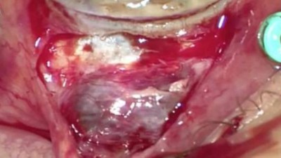 Image from case study_Treating complications of bleb needling_Intraoperative photo showing scleral thinning with uveal prolapse extending into the bleb area
