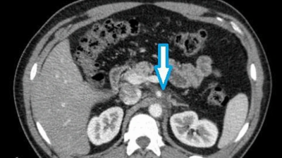 Abdominal CT of patient with isolated celiac artery vasculitis